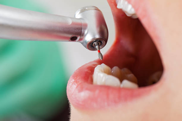 Best Knocked-Out Tooth (Avulsed Tooth) Treatment in Brainerd, MN